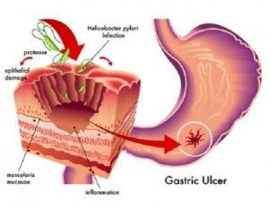 efecto del tabaquismo en el sistema digestivo