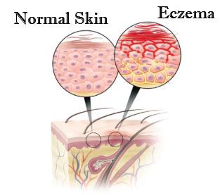 Top 12 Remedios naturales para el eczema