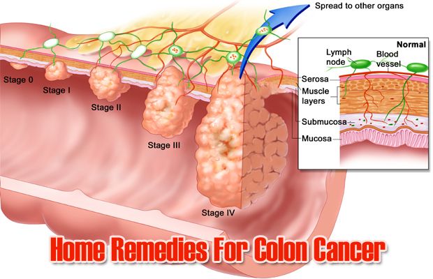 Top 5 remedios caseros para el cáncer de colon