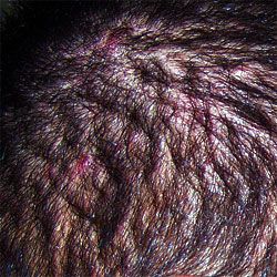 scalp_infection
