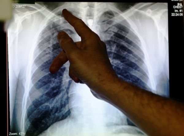 Factores de riesgo El Tiempo Aumento de abrigo para las infecciones pulmonares crónicas