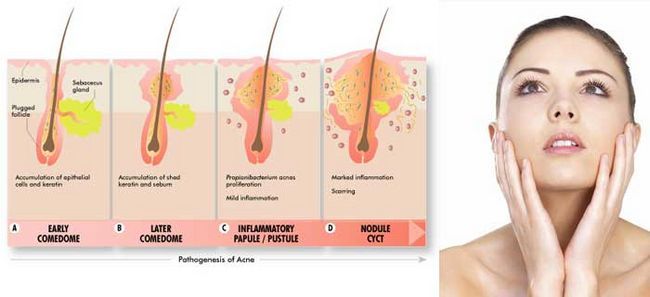 ¿Qué es el acné y causa el acné