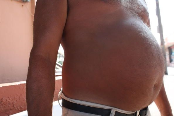 Tener la obesidad abdominal puede ser una parte del síndrome metabólico, que afecta a aproximadamente uno de cada tres estadounidenses.