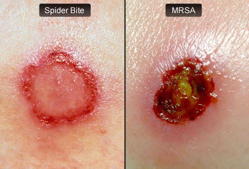 ¿Qué es el MRSA infección por estafilococos
