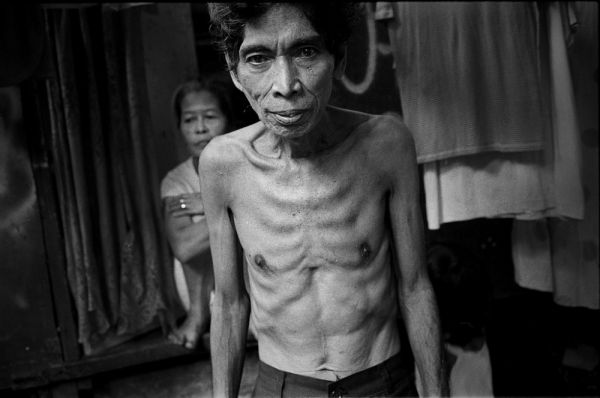 Más de 3 millones de casos de tuberculosis sin diagnosticar y sin tratar.