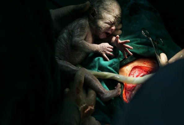 La mujer saca sus bebés gemelos por su cuenta durante la cesárea