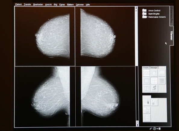 Algunas pautas llaman para que las mujeres comiencen a hacerse mamografías a los 50 años, pero muchos todavía comienzan antes de esa fecha.