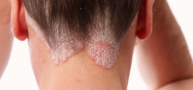 10 efectivos remedios caseros para la psoriasis del cuero cabelludo