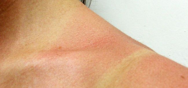 10 remedios caseros simples para Tratar Las quemaduras de sol