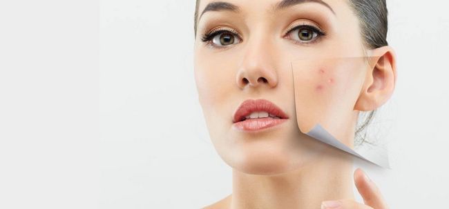 10 remedios simples para el tratamiento de acné de la piel seca