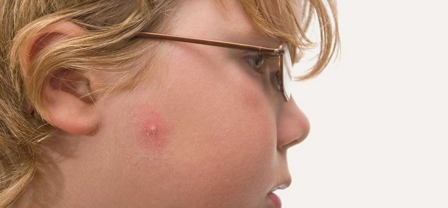 11 Diferentes tipos de acné y cómo identificarlos?