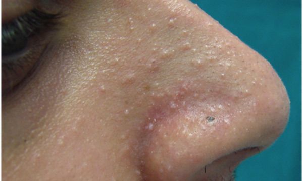 pápulas de acné