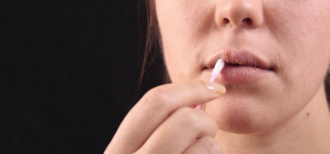 11 maneras de deshacerse de una noche a la mañana herpes labial