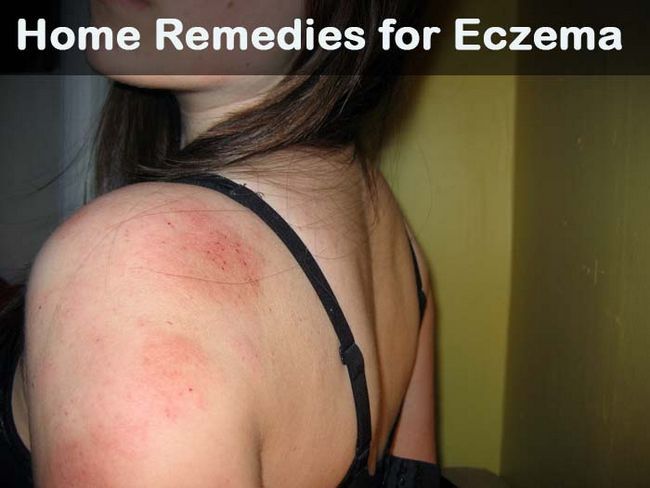 14 remedios caseros para el eczema Diy