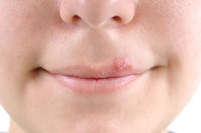 Se usa para tratar el herpes labial