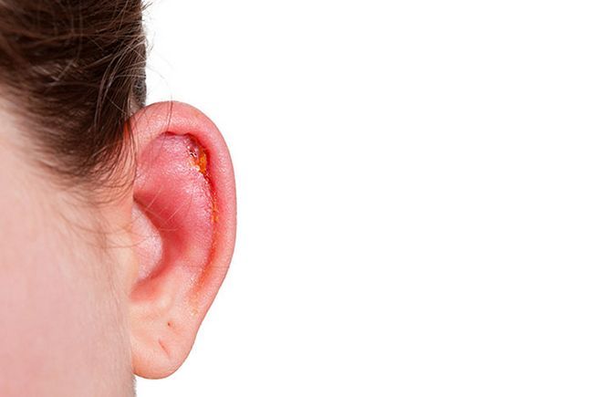 Se usa para tratar las infecciones del oído