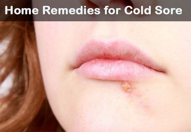 18 remedios caseros para el herpes labial Diy