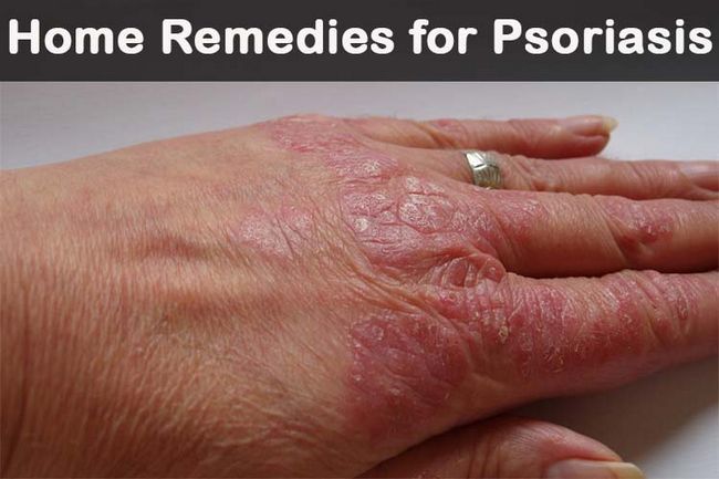 20 remedios caseros para la psoriasis Diy