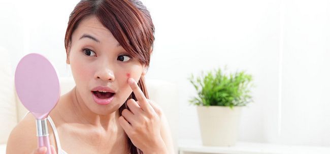 20 Consejos eficaces para curar y prevenir el acné adolescente