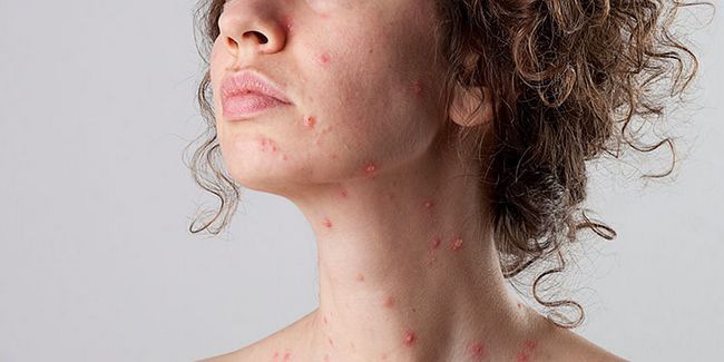 21 remedios caseros para la varicela Diy
