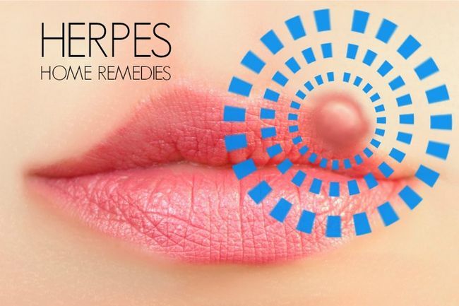 21 remedios caseros para el herpes Diy