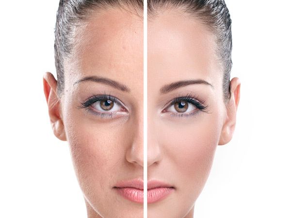 Trucos de belleza para las espinillas