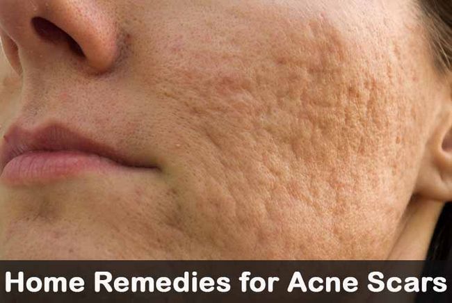 25 remedios caseros de bricolaje para las cicatrices del acné