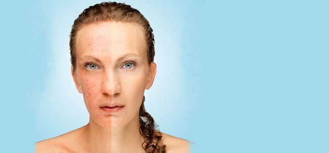 25 Consejos simples para quitar pigmentación de la piel