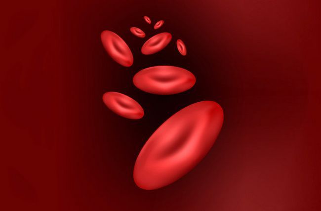 La incidencia de la anemia causada por deficiencia de hierro