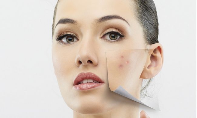 37 remedios caseros para el acné Diy