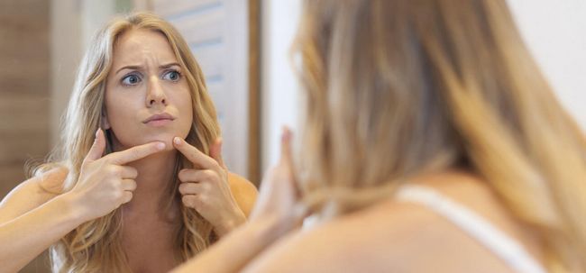 5 maneras simples para deshacerse de acné Chin