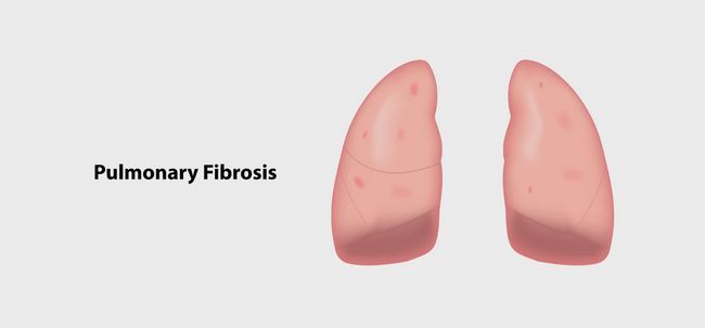 8 eficaces remedios caseros para tratar la fibrosis pulmonar