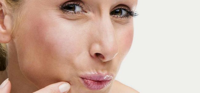 9 maneras de cuidar de las espinillas en la boca y los labios