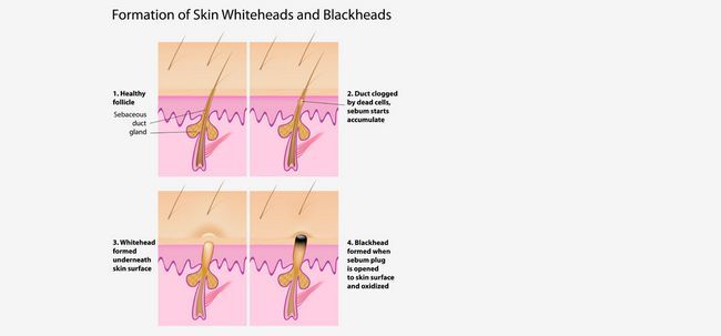 Puntos negros y blancos: Principio del acné