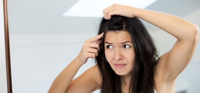 ¿Puede la caspa causar pérdida de cabello?
