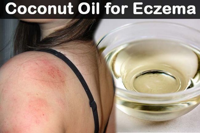 El aceite de coco para el eczema