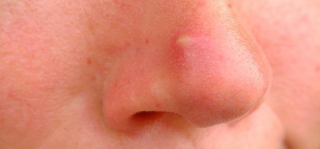 El acné quístico - ¿Qué es y cómo curarla?