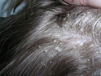 Remedios caseros para la caspa para el cabello seco