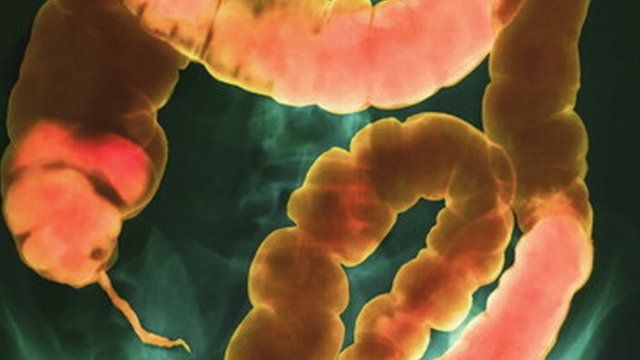 Cápsulas fecales un nuevo hallazgo para deshacerse de la infección intestinal