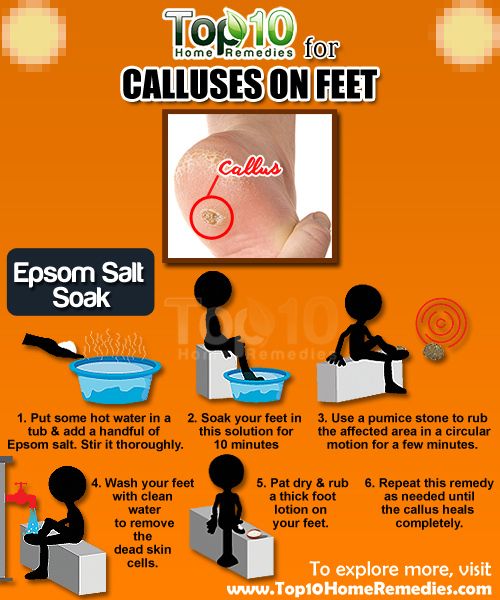 remedios caseros para los callos