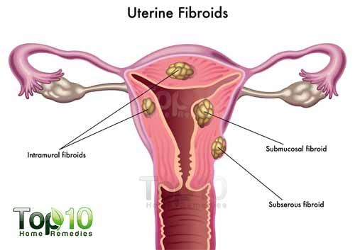 uterinos-fibromas-500