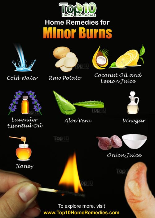 remedios caseros para las quemaduras menores