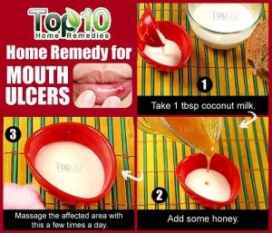 La leche de coco para las úlceras bucales
