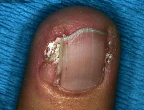 Remedios caseros para los tumores de uñas