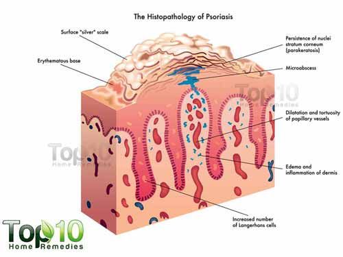 diagrama de la psoriasis