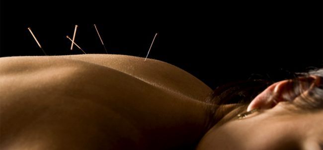 ¿Cómo funciona la acupuntura ayuda cura el dolor de espalda?
