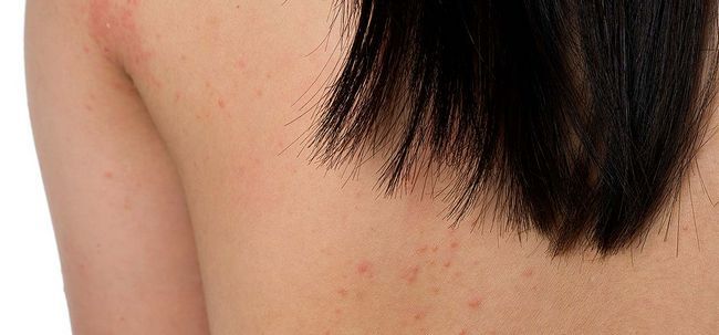 Cómo tratar con eczema?