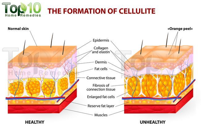 diagrama de la celulitis