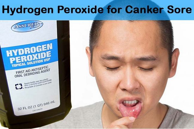 El peróxido de hidrógeno para el afta bucal