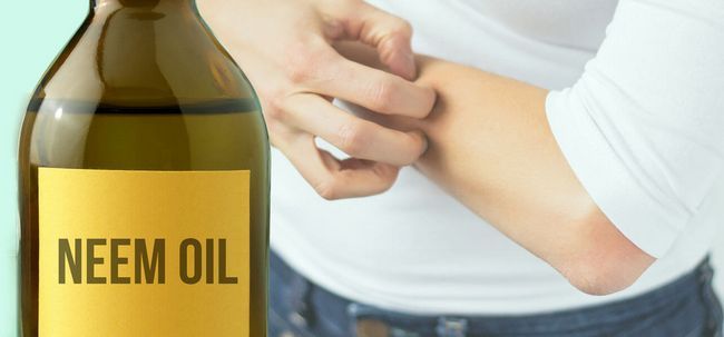 Es el aceite de Neem útil para tratar la sarna?